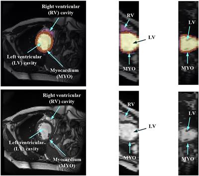 Myocardial Segmentation of Cardiac MRI Sequences With Temporal Consistency for Coronary Artery Disease Diagnosis